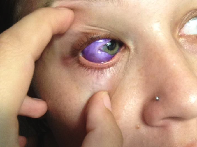Sclera tattoo: Don't ink your eyeball. Just don't do it.